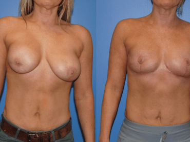 Breast Reconstruction Post Lumpectomy and Radiation Therapy