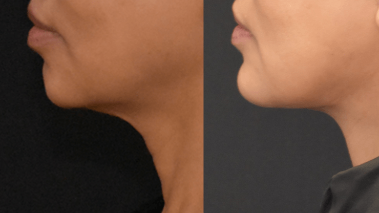 Lower Face & Neck Lift with Chin Implant