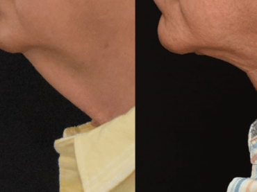 Lower Face & Neck Lift