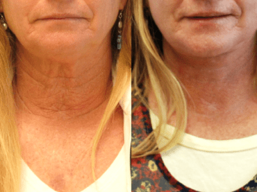 Lower Face and Neck Lift for Crepey Skin of the Neck