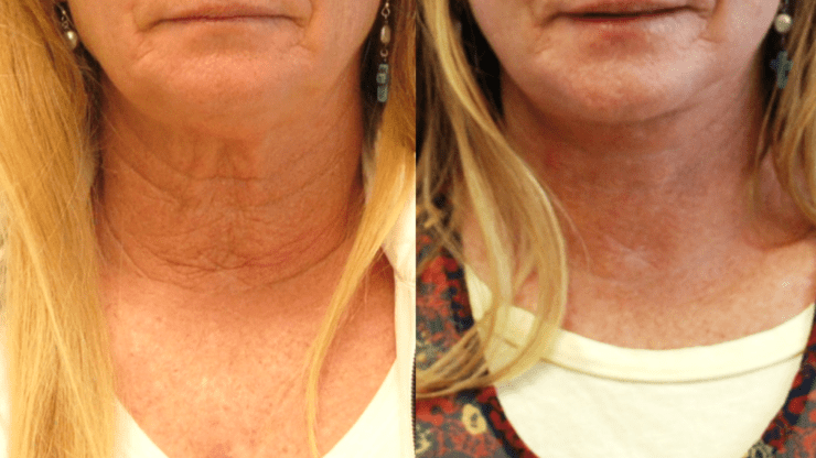 Lower Face and Neck Lift for Crepey Skin of the Neck