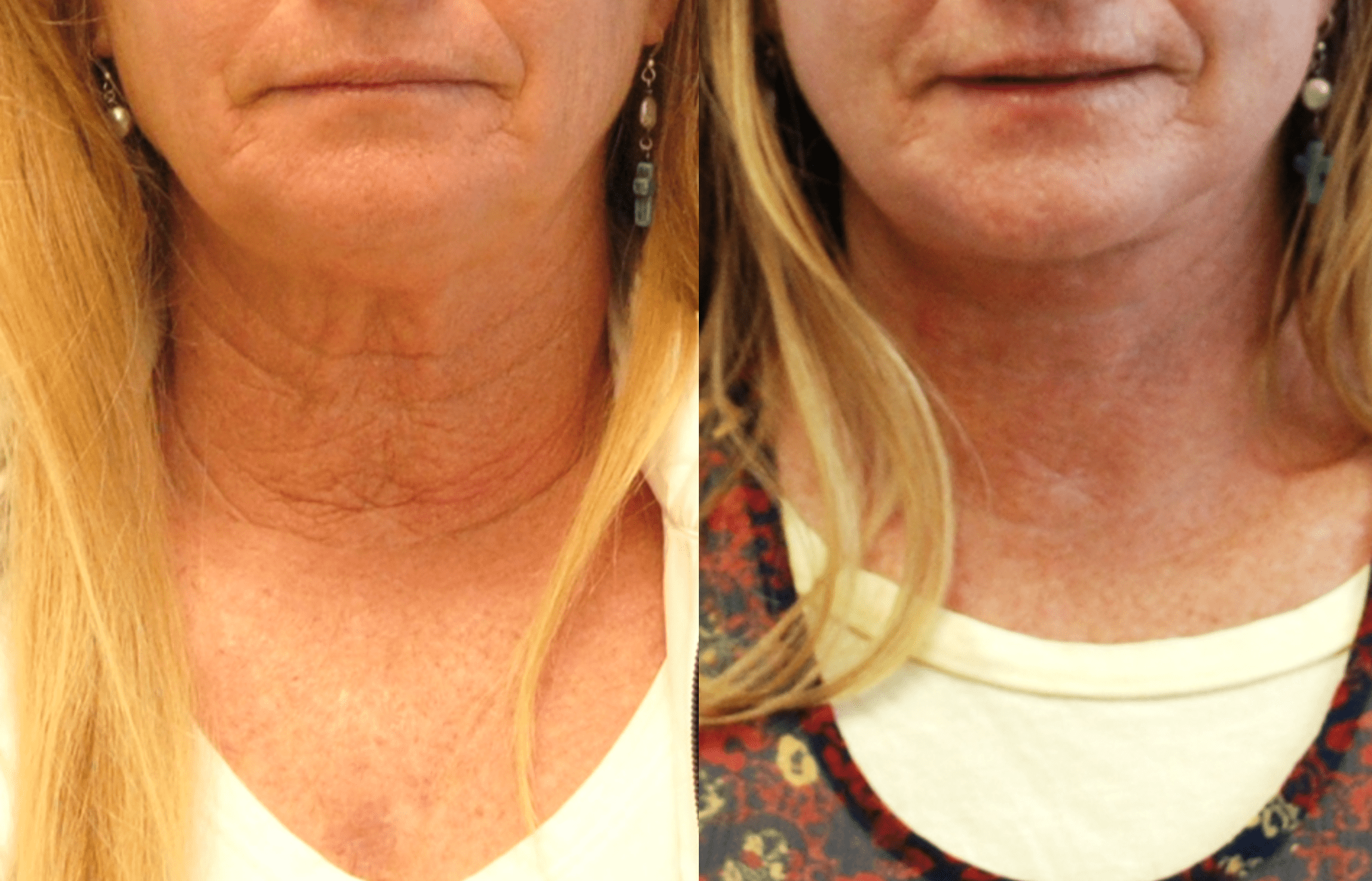 Lower Face and Neck Lift for Crepey Skin of the Neck - Brian P ...