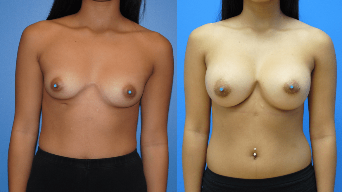 Breast Augmentation for Breast Symmetry