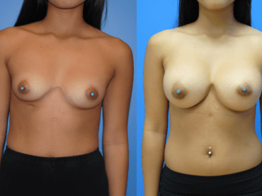 Breast Augmentation for Breast Symmetry