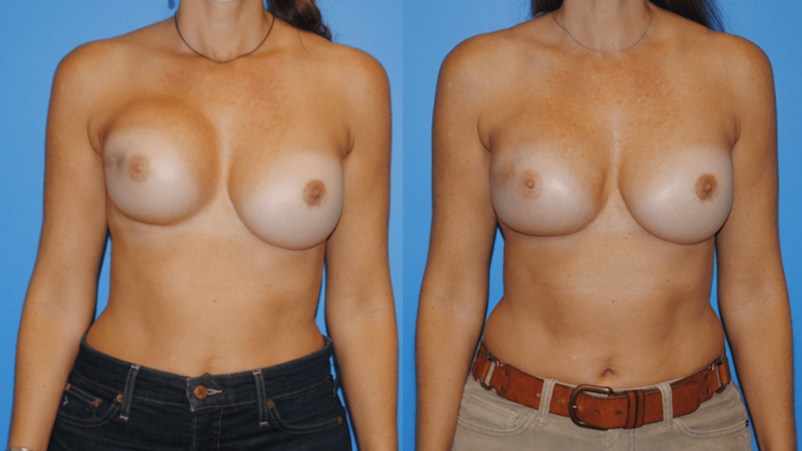 Capsular Contracture and Radiation Post Lumpectomy.