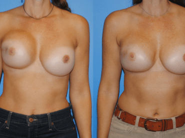 Capsular Contracture and Radiation Post Lumpectomy.