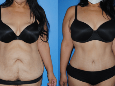 Abdominoplasty and The Belly Button