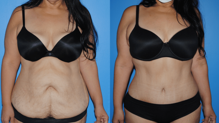 Abdominoplasty and The Belly Button