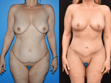 Anterior Body Lift After Massive Weight Loss