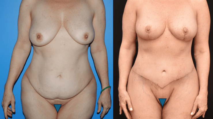 Anterior Body Lift After Massive Weight Loss