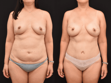 Bilateral Mastectomy Breast Reconstruction with DIEP Flaps