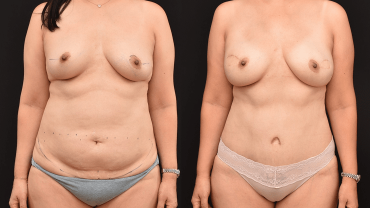 Bilateral Mastectomy Breast Reconstruction with DIEP Flaps