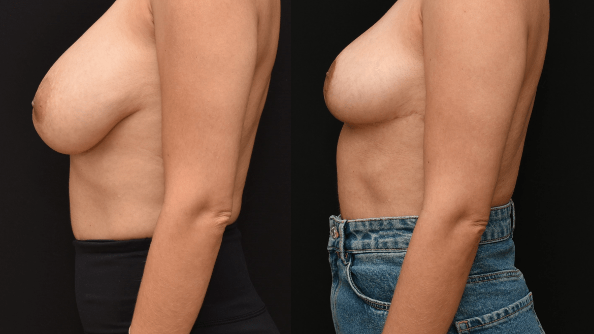 Breast Reduction Surgery