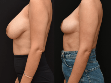 Breast Reduction Surgery