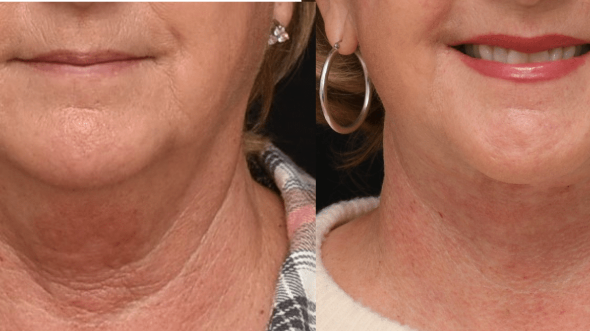 Lower Face and Neck Lift Surgery