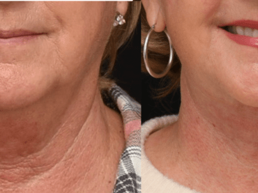 Lower Face and Neck Lift Surgery