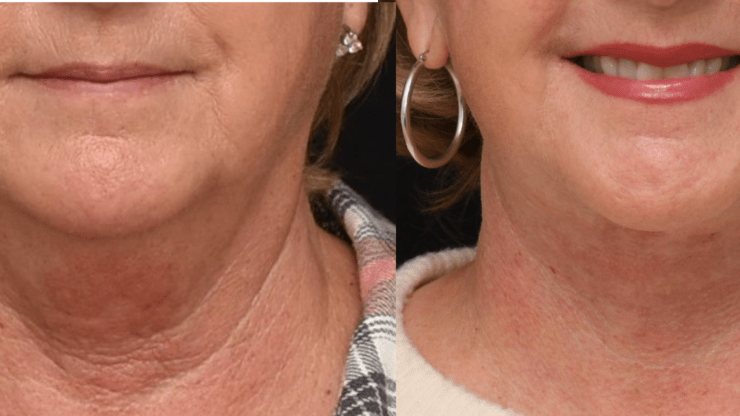 Lower Face and Neck Lift Surgery