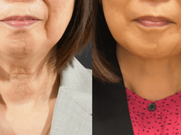 Lower Face & Neck Lift for Facial Rejuvenation