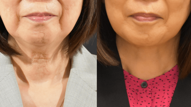 Lower Face & Neck Lift for Facial Rejuvenation