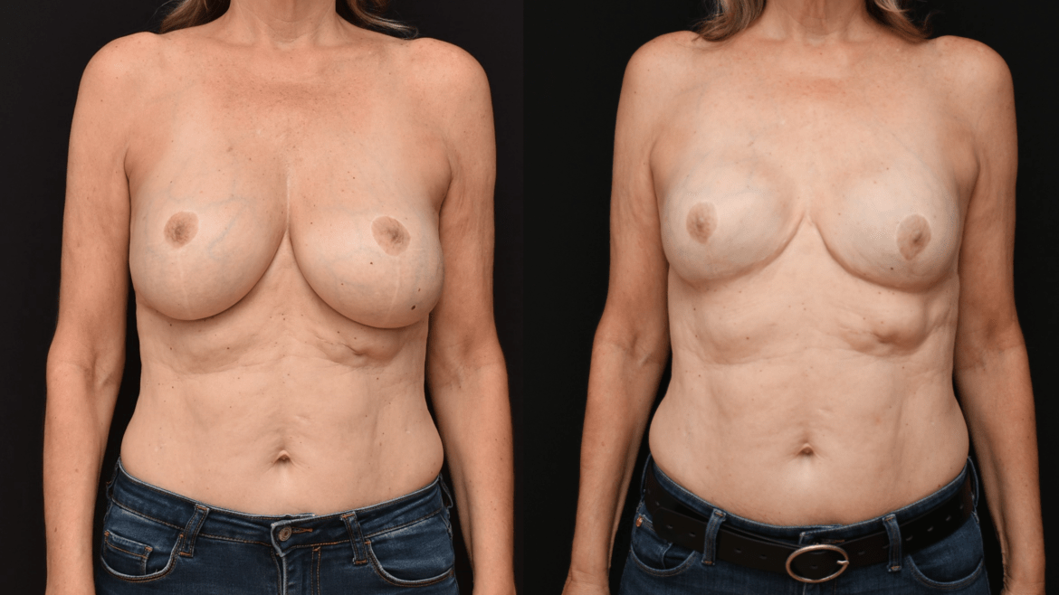 Breast Cancer Mastectomy Reconstruction.