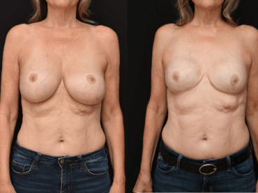 Breast Cancer Mastectomy Reconstruction.