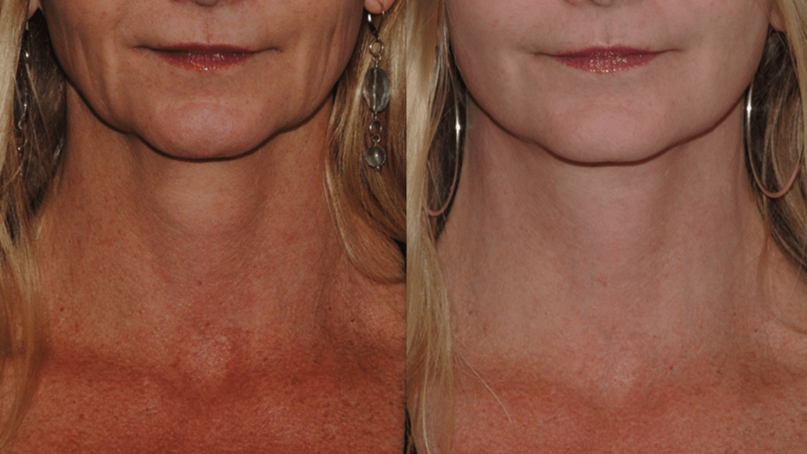 Improving the Jowls with Lower Face and Neck Lift Surgery