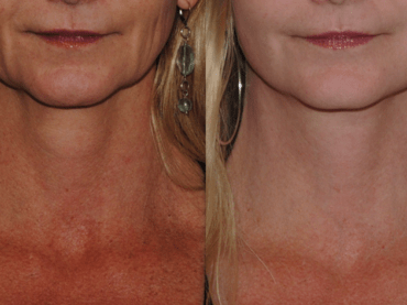 Improving the Jowls with Lower Face and Neck Lift Surgery