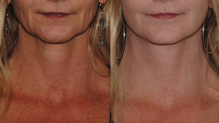 Improving the Jowls with Lower Face and Neck Lift Surgery