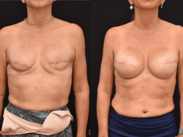 Breast Cancer Reconstruction with Tissue Expanders and Implants