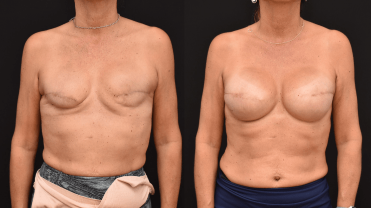 Breast Cancer Reconstruction with Tissue Expanders and Implants