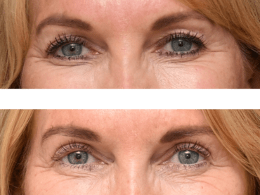 Upper Blepharoplasty