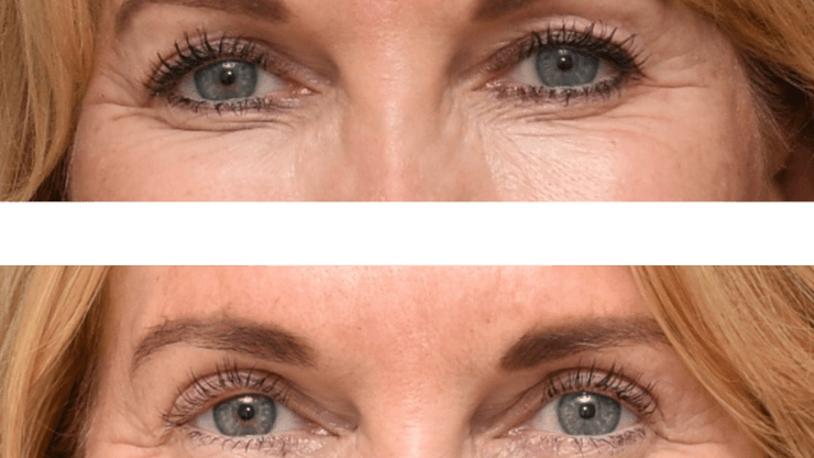 Upper Blepharoplasty