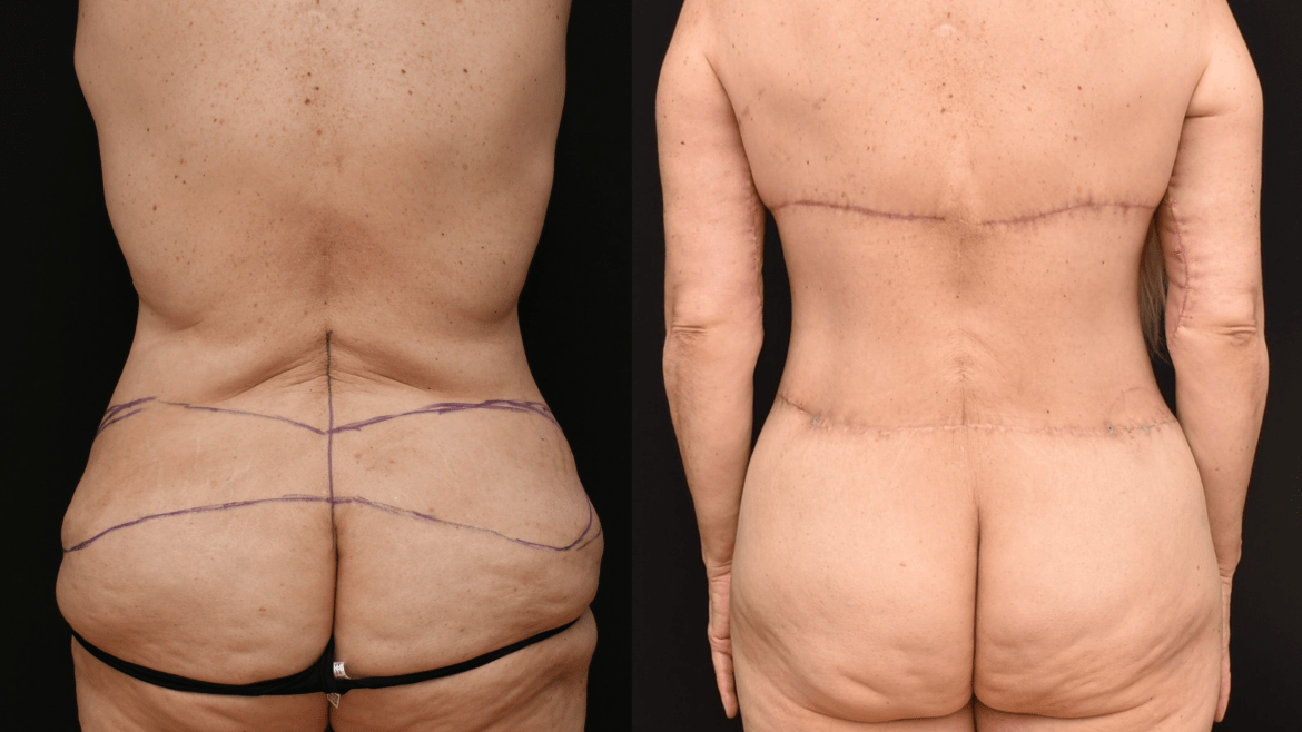 Posterior Trunk Body Lift Early Post-Operative Results