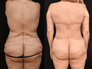 Posterior Trunk Body Lift Early Post-Operative Results