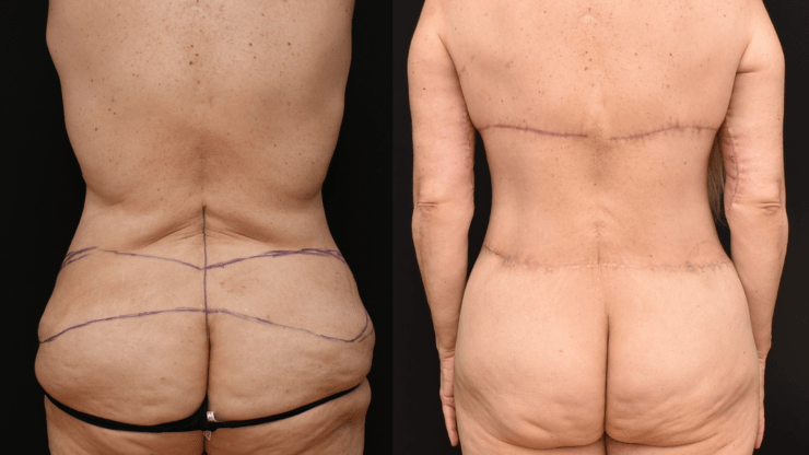 Posterior Trunk Body Lift Early Post-Operative Results