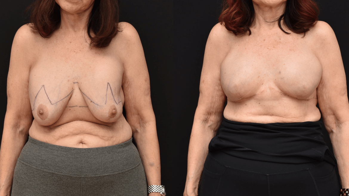 Mastectomy Breast Reconstruction