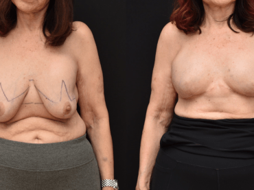 Mastectomy Breast Reconstruction