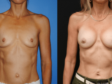 Breast Augmentation Longevity and Implant Volume. Breast Augmentation Greater than One Decade Follow-Up