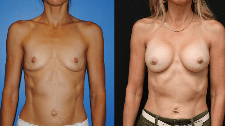 Breast Augmentation Longevity and Implant Volume. Breast Augmentation Greater than One Decade Follow-Up