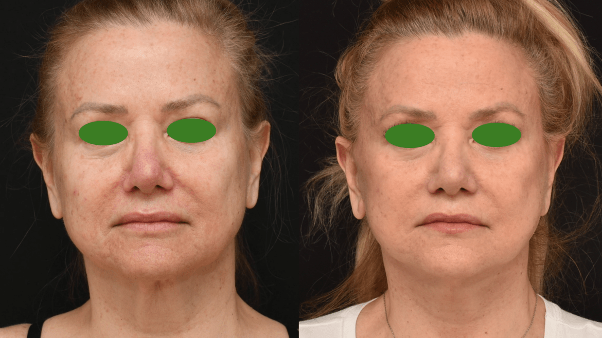 Lower Face and Neck Lift Surgery