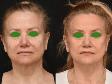 Lower Face and Neck Lift Surgery