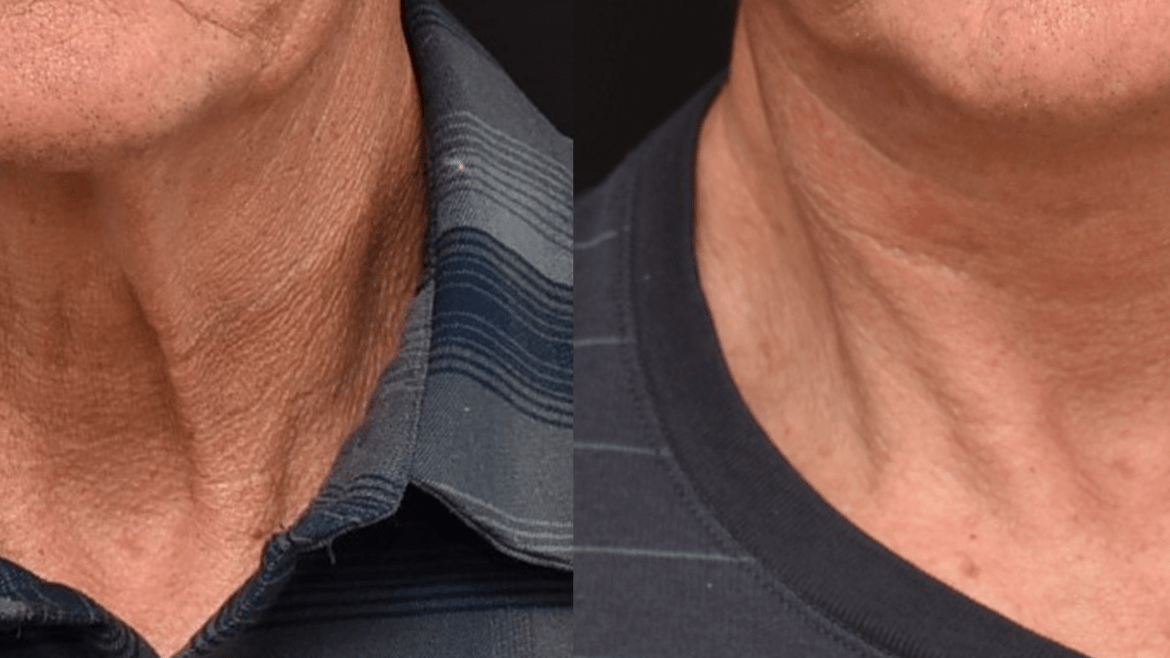 Lower Face and Neck Lift Surgery