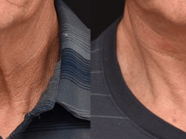 Lower Face and Neck Lift Surgery