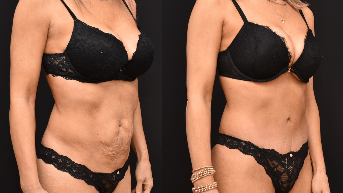 Abdominoplasty Newport Beach, CA Brian P. Dickinson, M.D.