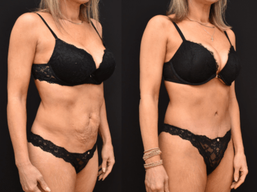 Abdominoplasty Newport Beach, CA Brian P. Dickinson, M.D.