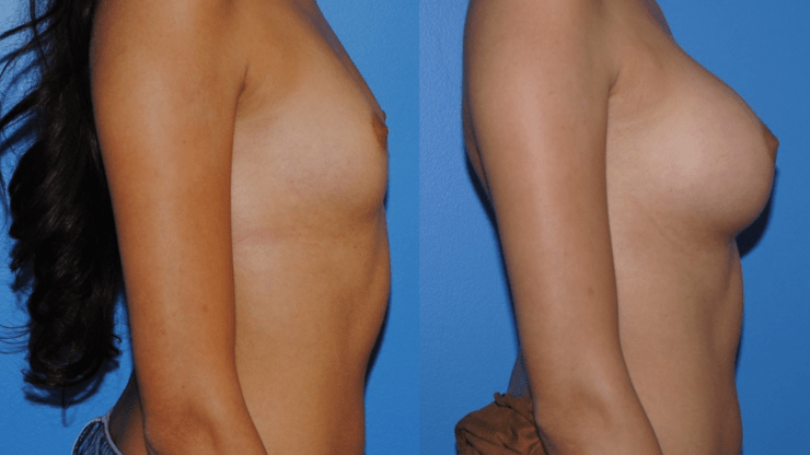 Breast Augmentation and Breast Augmentation Longevity. Brian P. Dickinson, M.D. Newport Beach, CA