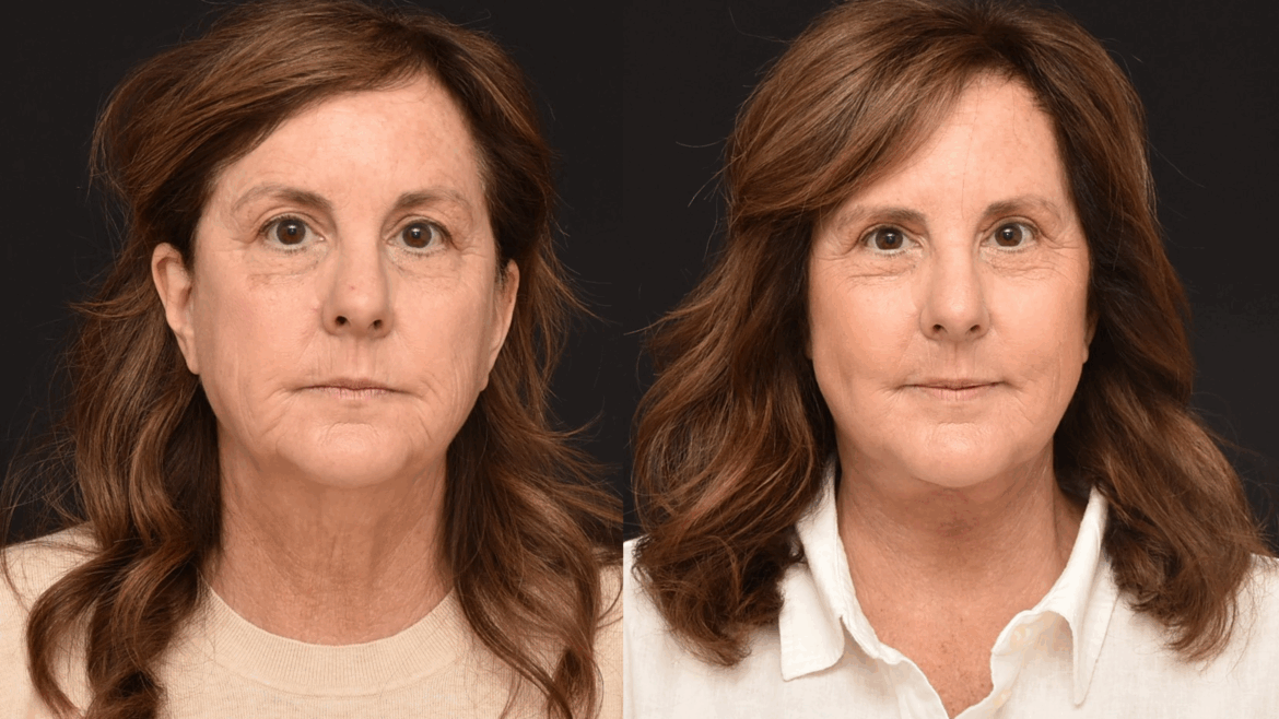Lower Face and Necklift & Upper Blepharoplasty