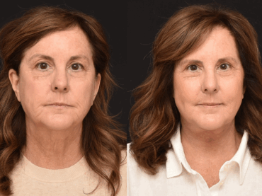 Lower Face and Necklift & Upper Blepharoplasty
