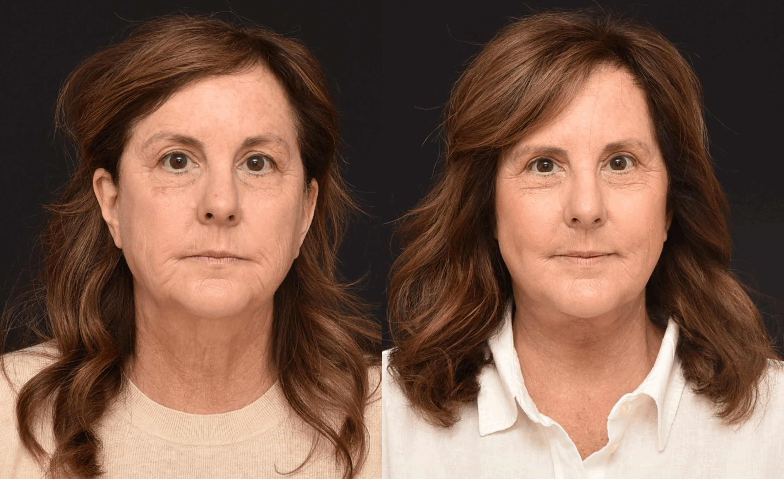 Lower Face and Neck lift Brian Dickinson, M.D