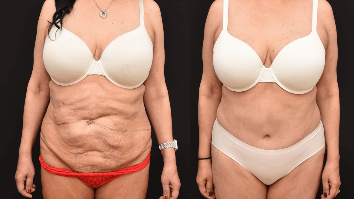 Abdominoplasty to Improve Abdominal Contour